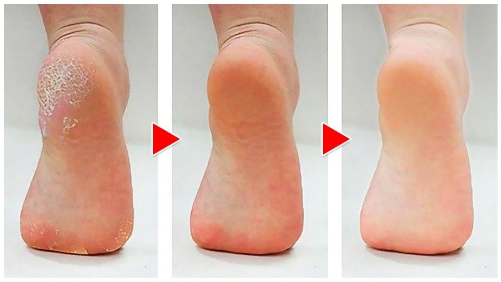 Callus Feet Transformation