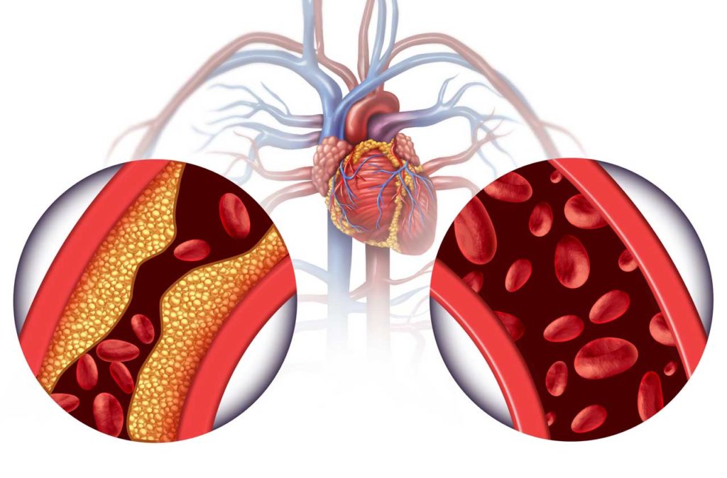 3D Chelation Therapy and Heart Disease Treatment Concept