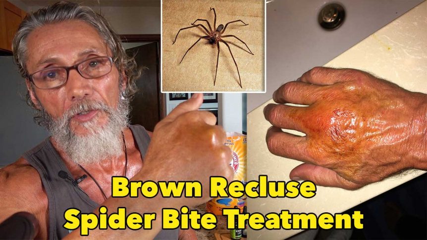 Brown Recluse Spider Bite Treatment