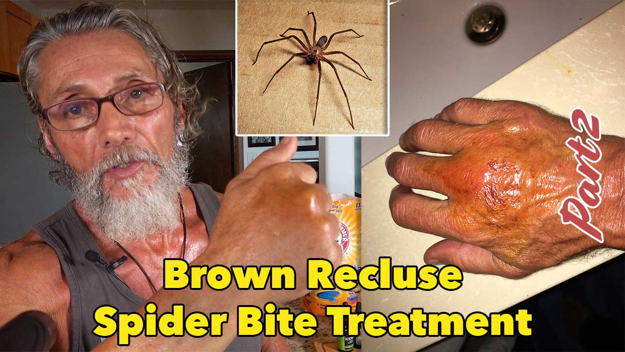 Brown Recluse Spider Bite Stages